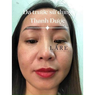 Peel Da bằng Serum Mỹ Phẩm Thanh Dược lare