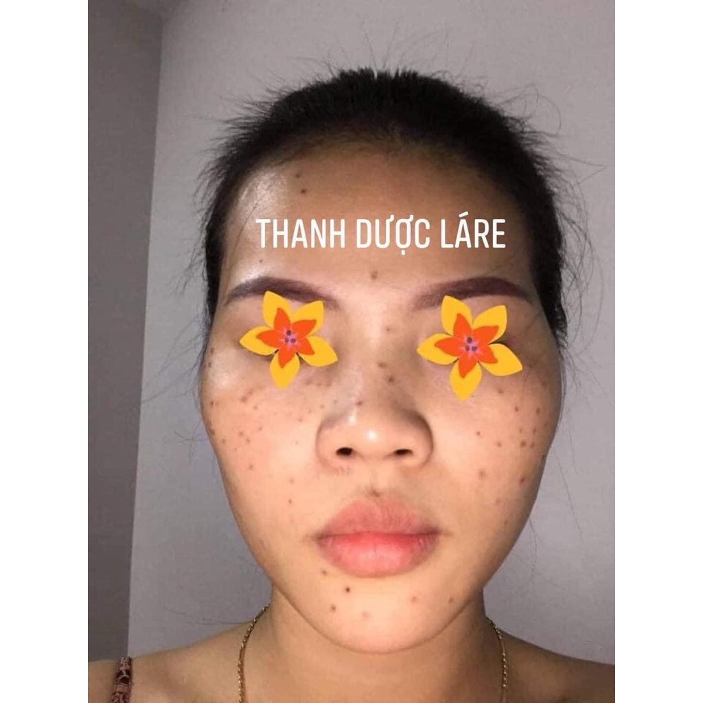 BỘ ĐÔI THẦN THÁNH CHO LÀN DA KHÔNG NÁM KHÔNG TÀN NHANG HERBAL SERUM VER.2 VÀ SỮA RỬA MẶT LÁRE THANH DƯỢC.