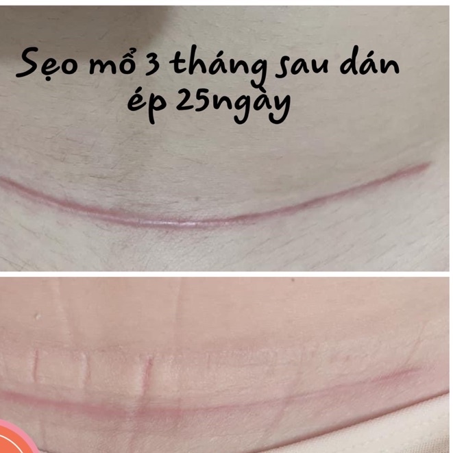Miếng dán ép sẹo lồi Hisamitsu hàng chính hãng nội địa Nhật  - Konni39 Hải Châu