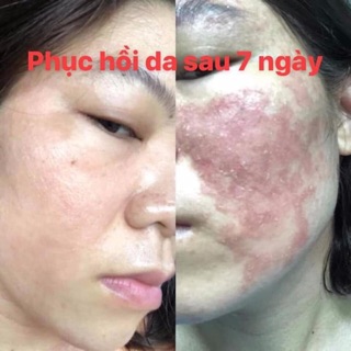 PHỤC HỒI BEEN CHO DA HƯ TỔN