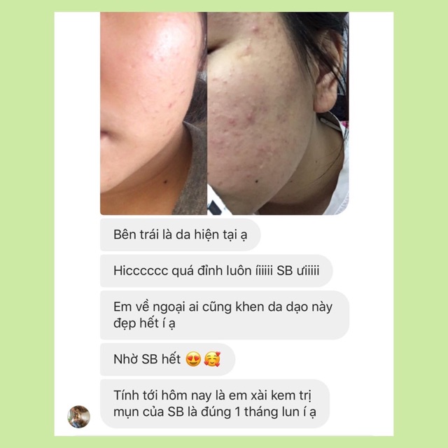 Kem mụn handmade Sunday Beauty | BigBuy360 - bigbuy360.vn