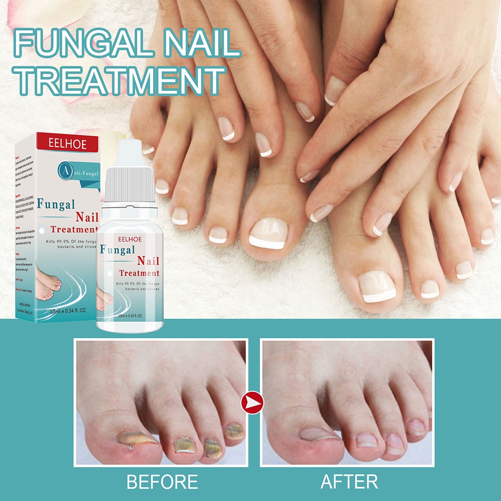 Eelhoe 10ml Nail sửa chữa nuôi dưỡng giữ ẩm chống-barb nấm giải pháp chăm sóc