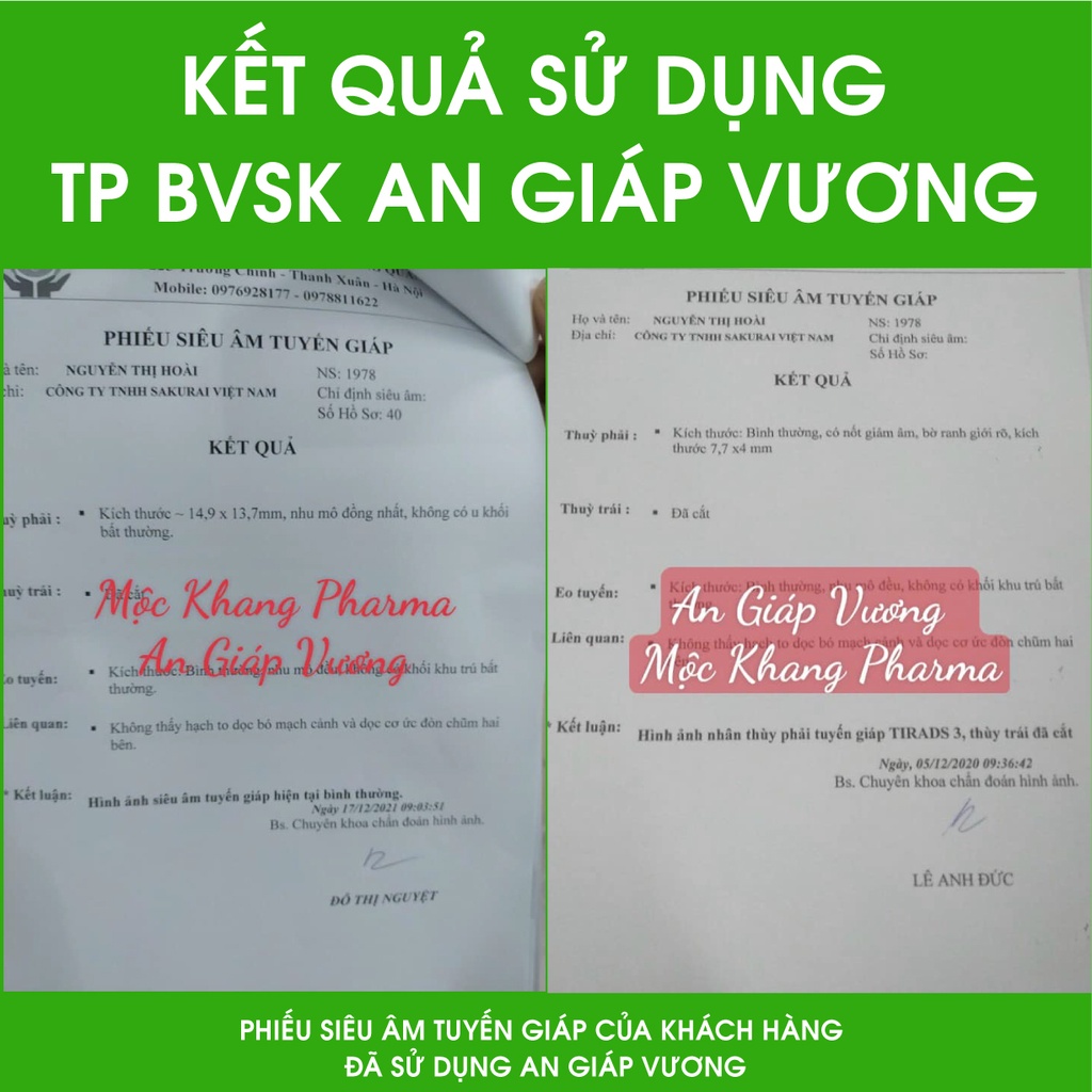 An Giáp Vương Hỗ Trợ Giảm sự phát triển của Bướu Cổ Lành Tính Liệu Trình Từ 1 đến 3 Tháng