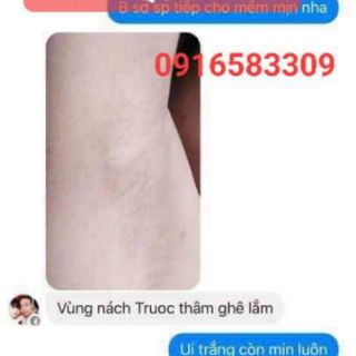PEEL TCA CHẤM DỨT THÂM NÁCH