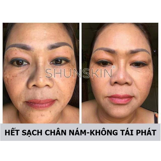 SHUN SKIN DIỆT TRỪ MỤN ĐẦU ĐEN XÓA TAN VẾT NÁM