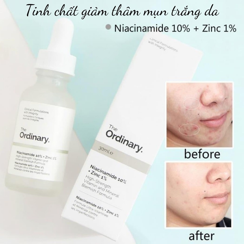Serum The Ordinary Niacinamide 10% + Zinc 1% – Serum Chống Viêm, Giảm Kích Ứng Dành Cho Da Mụn