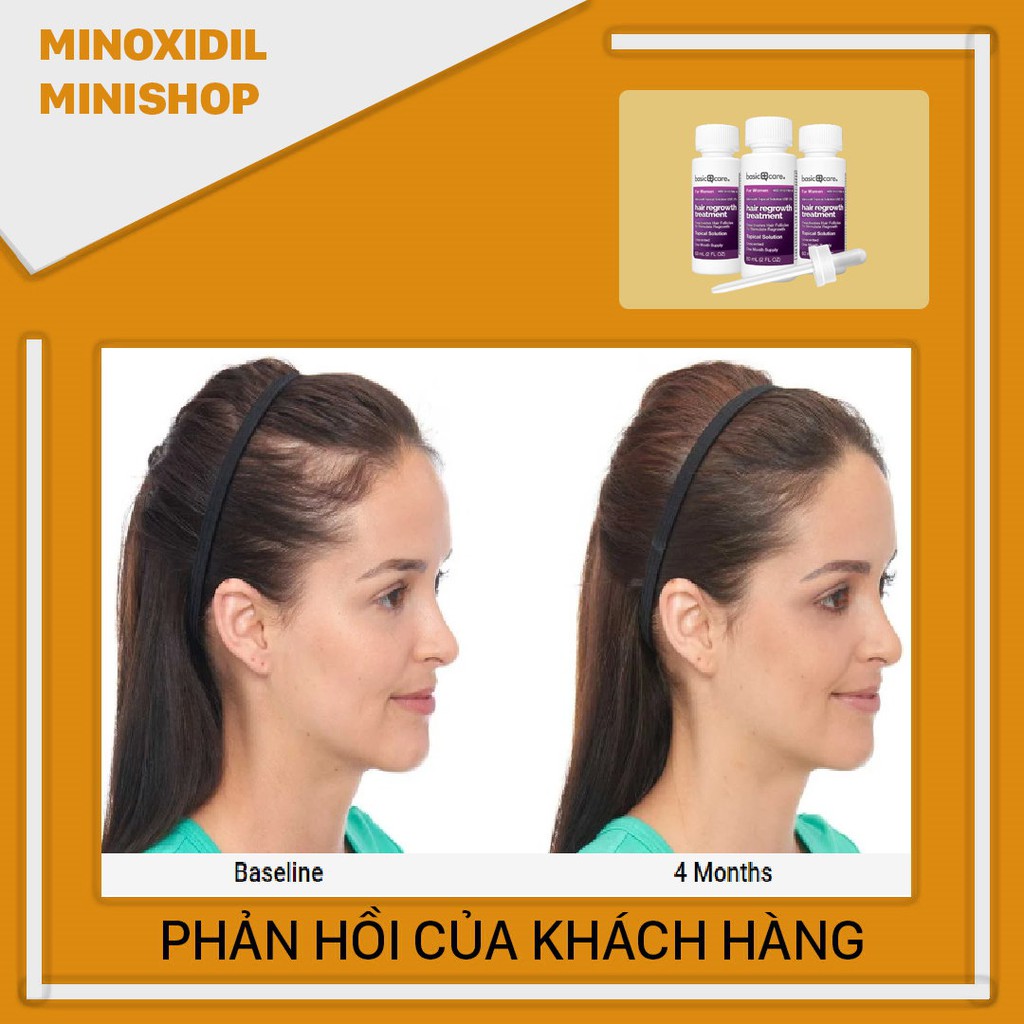 Thuốc Mọc Tóc, Lông Mày Minoxidil 2% Cho Nữ Basic Care