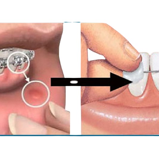 Sáp nha khoa giảm đau cho người niềng răng (5 Hộp)