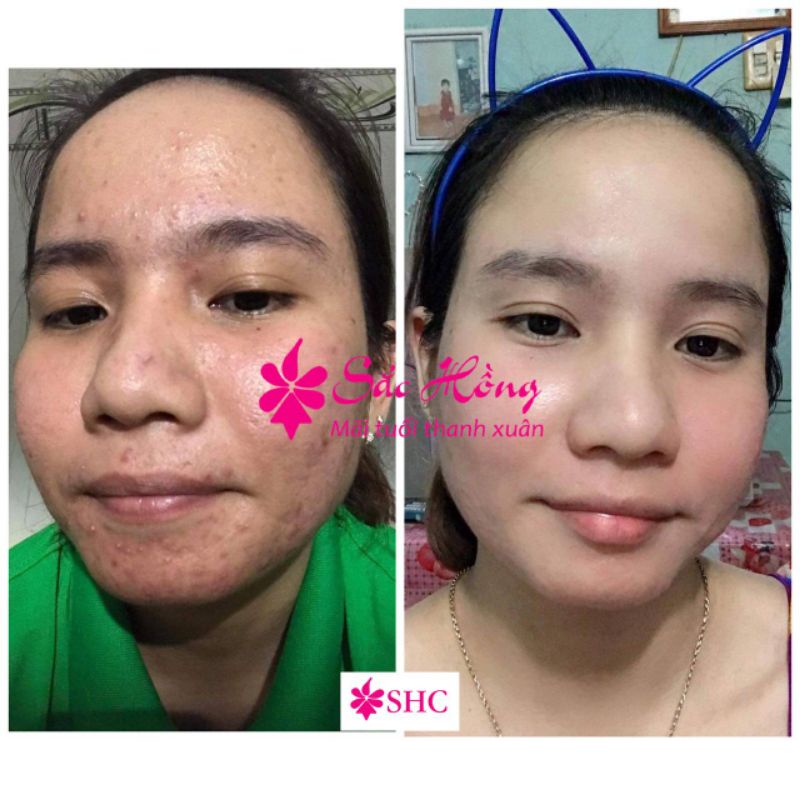 Tinh chất loại bỏ mụn - mờ nám Sắc Hồng 50ml - kiềm dầu - đều màu da - mờ thâm