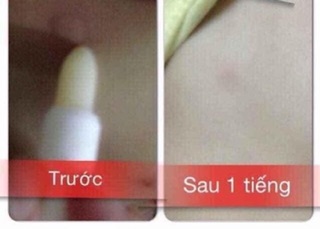 Son bôi muỗi 🦟 đốt