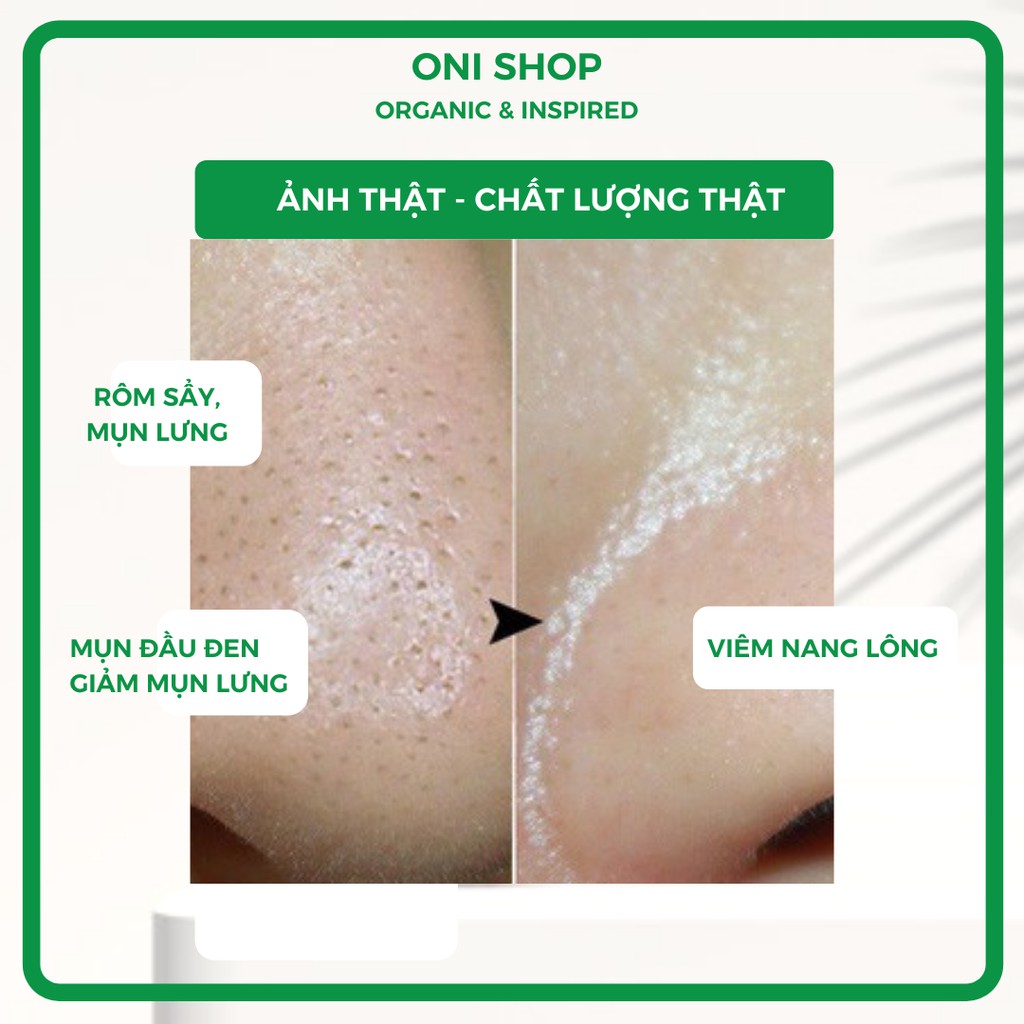 Xà phòng mụn lưng,mặt,rôm sẩy..✨FREESHIP TẶNG TÚI LƯỚI✨xà bông thiên nhiên phù hợp rửa mặt và toàn thân handmade-Onishop | BigBuy360 - bigbuy360.vn