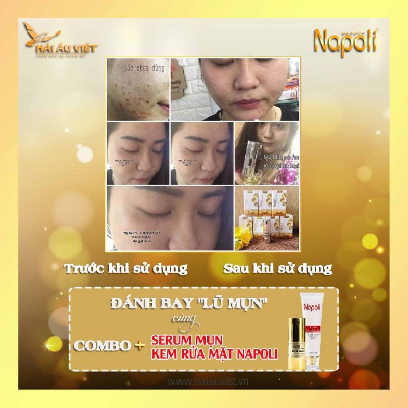 Serum trị mụn Napoli