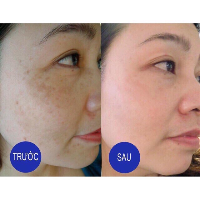 Trắng bền AZ (trẻ hoá da, xoá nếp nhăn, làm trắng da...) | Thế Giới Skin Care