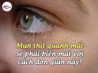 Kem mụn thịt Tsubuporon Nhật Bản