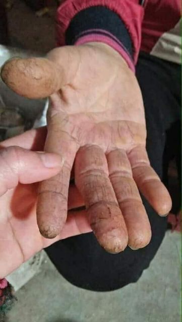 Mỡ trăn cao cấp trị nứt nẻ da và dưỡng da