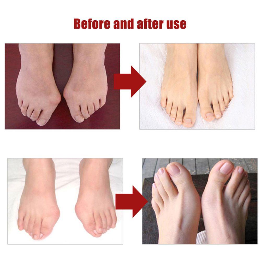 Dụng Cụ Tách Ngón Chân Bằng Silicone Tiện Dụng
