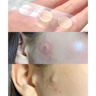 Miếng dán che mụn Somebymi 18 miếng