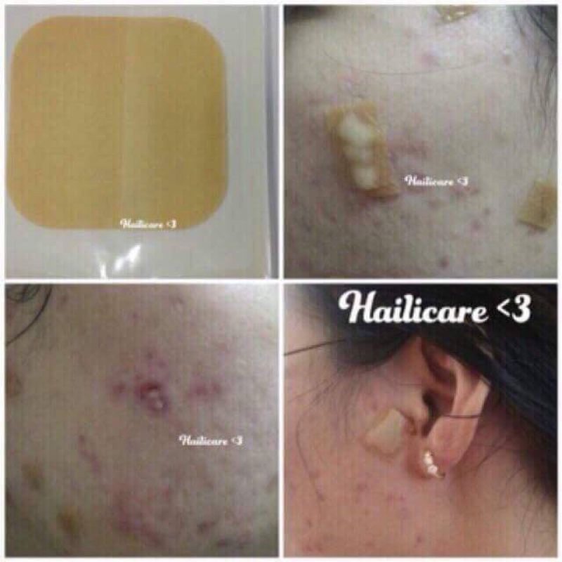 Miếng dán mụn Duoderm extra thin, miếng dán hút mủ chăm sóc da, chăm sóc vết thương