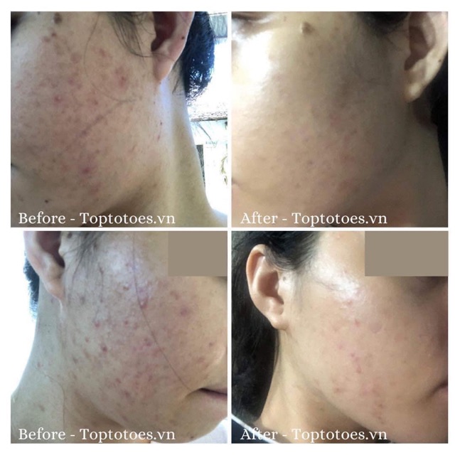 SERUM GIẢM VIÊM, MỤN TEANA ANTI-REDNESS SUPER PEPTIDES | Thế Giới Skin Care