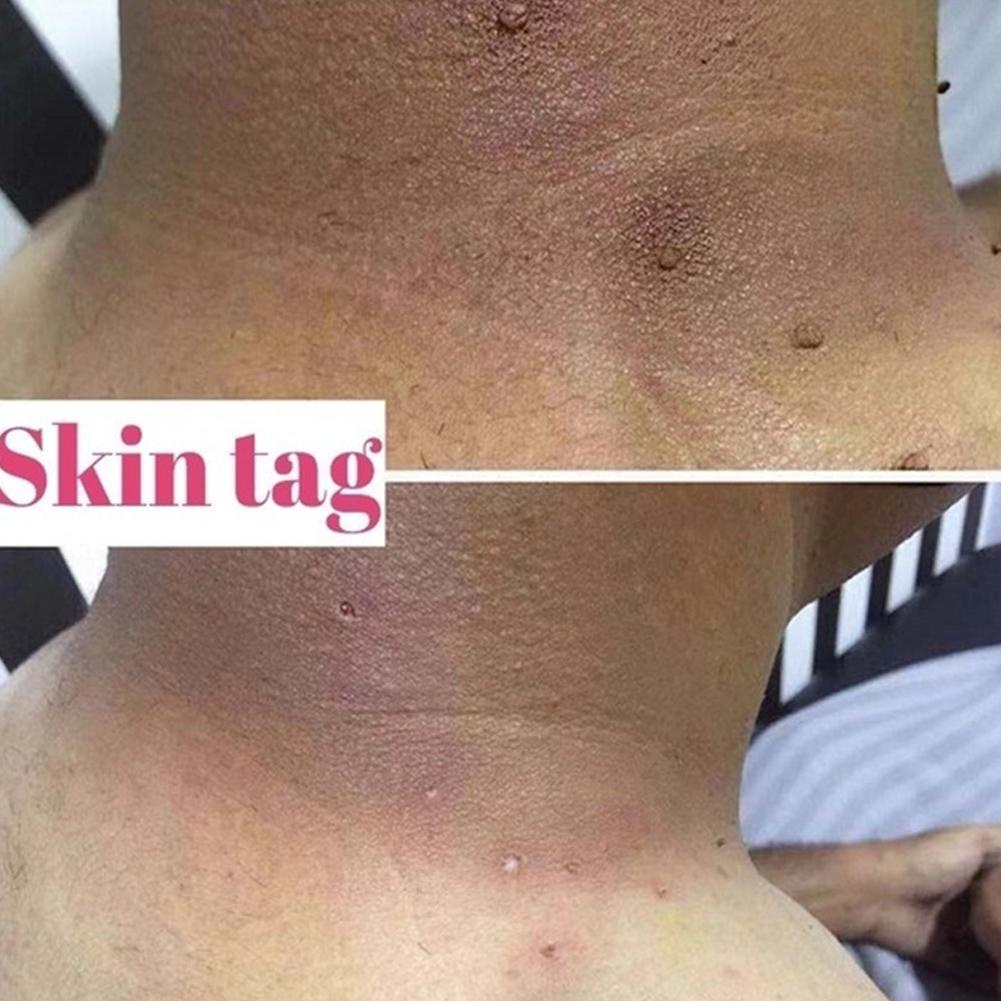 Dung Dịch Loại Bỏ Mụn Thịt Dư Trên Da M8H7