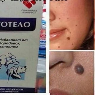 GEL TẨY NỐT RUỒI, MỤN CƠM, MỤN CÓC, SẸO LỒI,(Chính hãng nga) Gel Dvelinil hỗ trợ tẩy nốt ruồi,mụn ruồi, mụn cóc