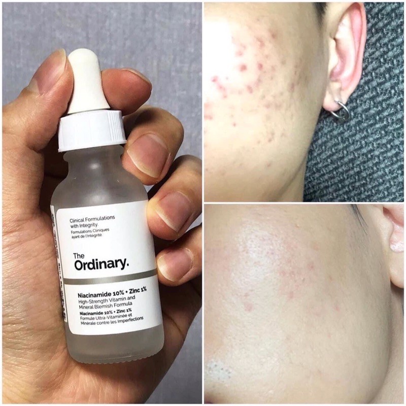 [ HÀNG CÓ SẴN] Serum The Ordinary Niacinamide 10% + Zinc 1%