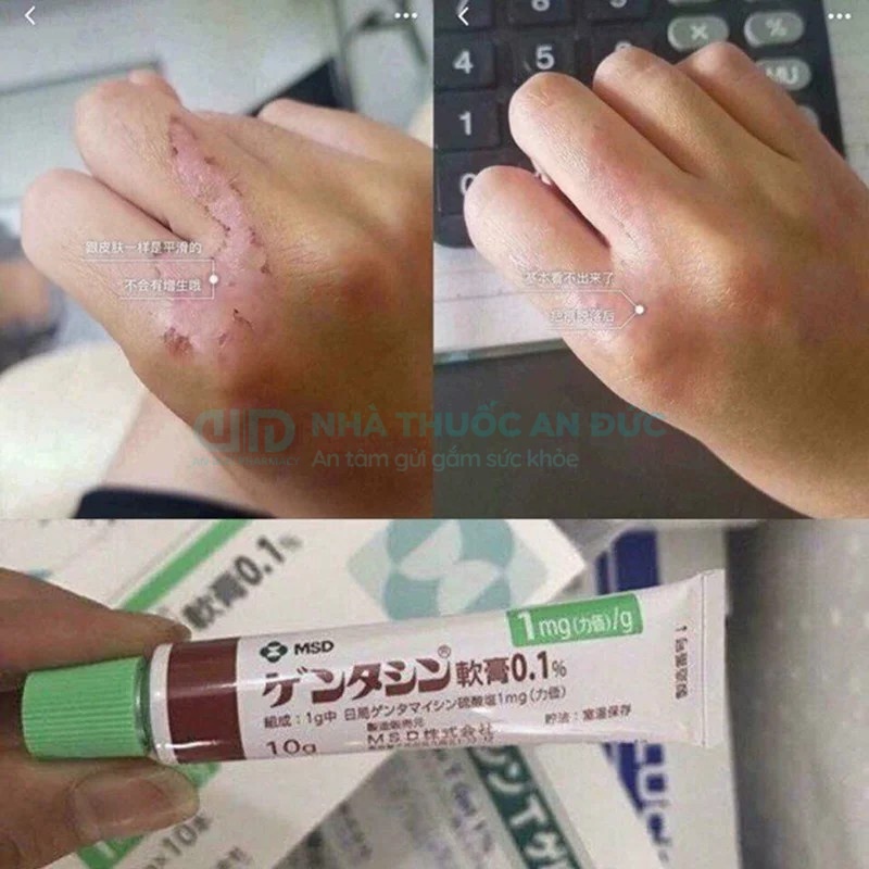 Gel Mờ Sẹo Mờ Thâm Gentacin 0.1% Nhật Bản Giúp Mờ Sẹo Mờ Thâm Nám, Sẹo Lồi, Sẹo Lõm – Nhà thuốc An Đức