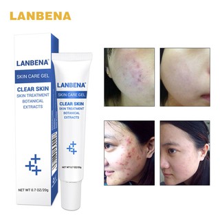 Kem trị mụn thần thánh lanbena 20g