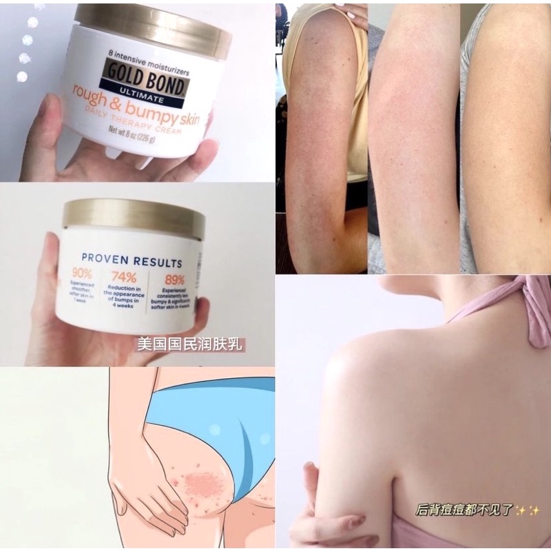 KEM DƯỠNG DA GOLD BOND ULTIMATE ROUGH & BUMPY SKIN 226gr - CHÍNH HÃNG