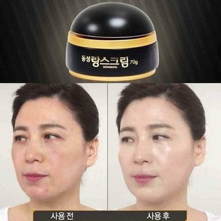 KEM TRỊ NÁM DONGSUNG