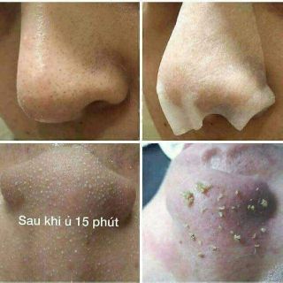 Ủ mụn thần thánh