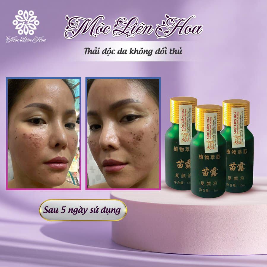 Mộc Liên Hoa Ultra Spot - Mờ nám, tàn nhang chính hãng - Huda shop