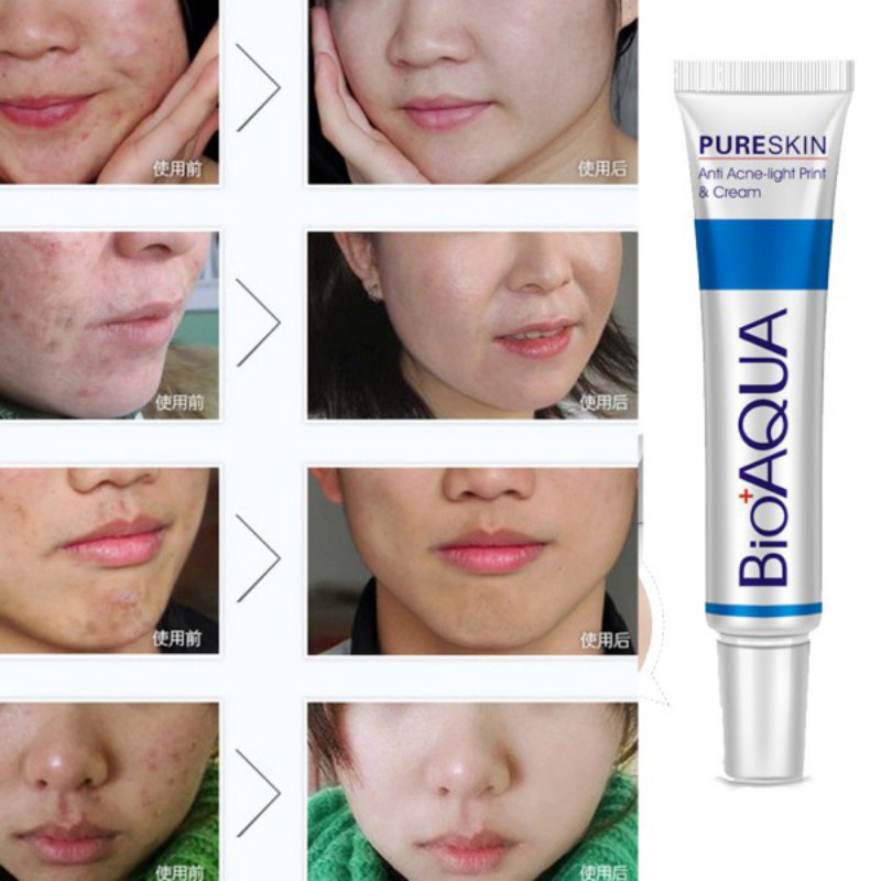 [Hàng mới về] Kem hỗ trợ giảm mụn Bioaqua cải thiện mụn trứng cá kiềm dầu sáng da 30g