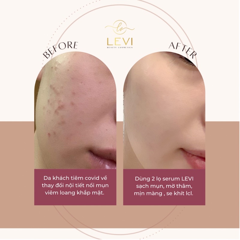 Serum mụn LEVI mờ thâm, trắng da, sạch mụn 100% sau 7 ngày | BigBuy360 - bigbuy360.vn