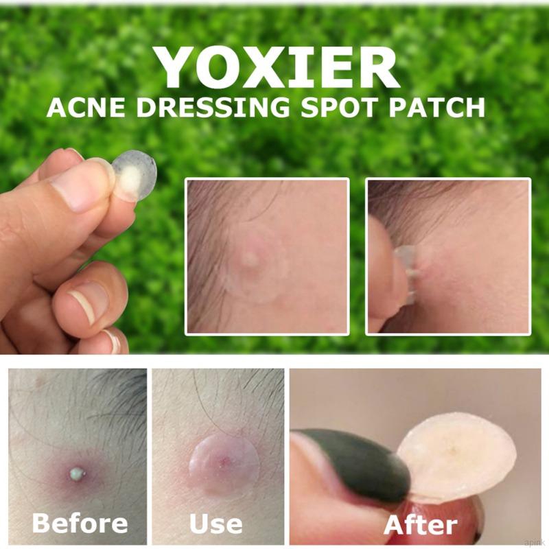 Set 36 Miếng Dán Hỗ trợ giảm mụn Thoáng Khí Không Đau Yoxier