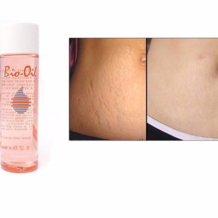 Tinh dầu chống rạn da bà bầu bio oil scar treatment làm hết rạn da mờ sẹo hết thâm da khi mang thai và sau sinh.