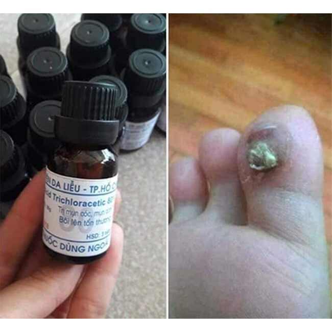 Dung Dịch Acid Trichloracetic 80% 15ml Loại Bỏ Các Loại Mụn Cóc Mụn Cơm Không Đau Rát An Toàn Cho Da Lọ