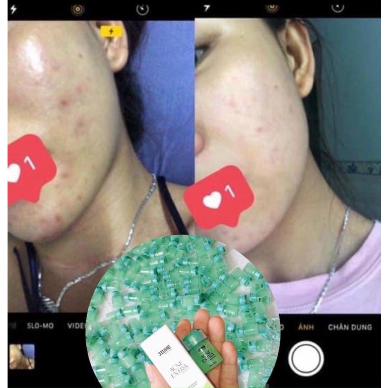 COMBO SERUM JIUHE THÂM VÀ SERUM JIUHE MỤN ACNES EXTRA THANH TÔ CHÍNH HÃNG 100%