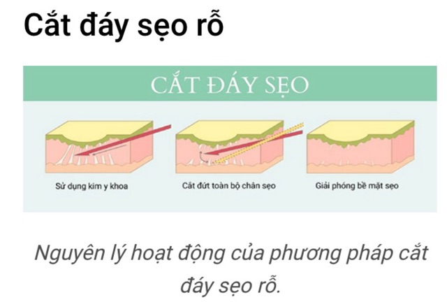 Kim Nokor siêu cứng bóc tách đáy sẹo rỗ lâu năm chuẩn y khoa Đức [Lẻ 1 cái]