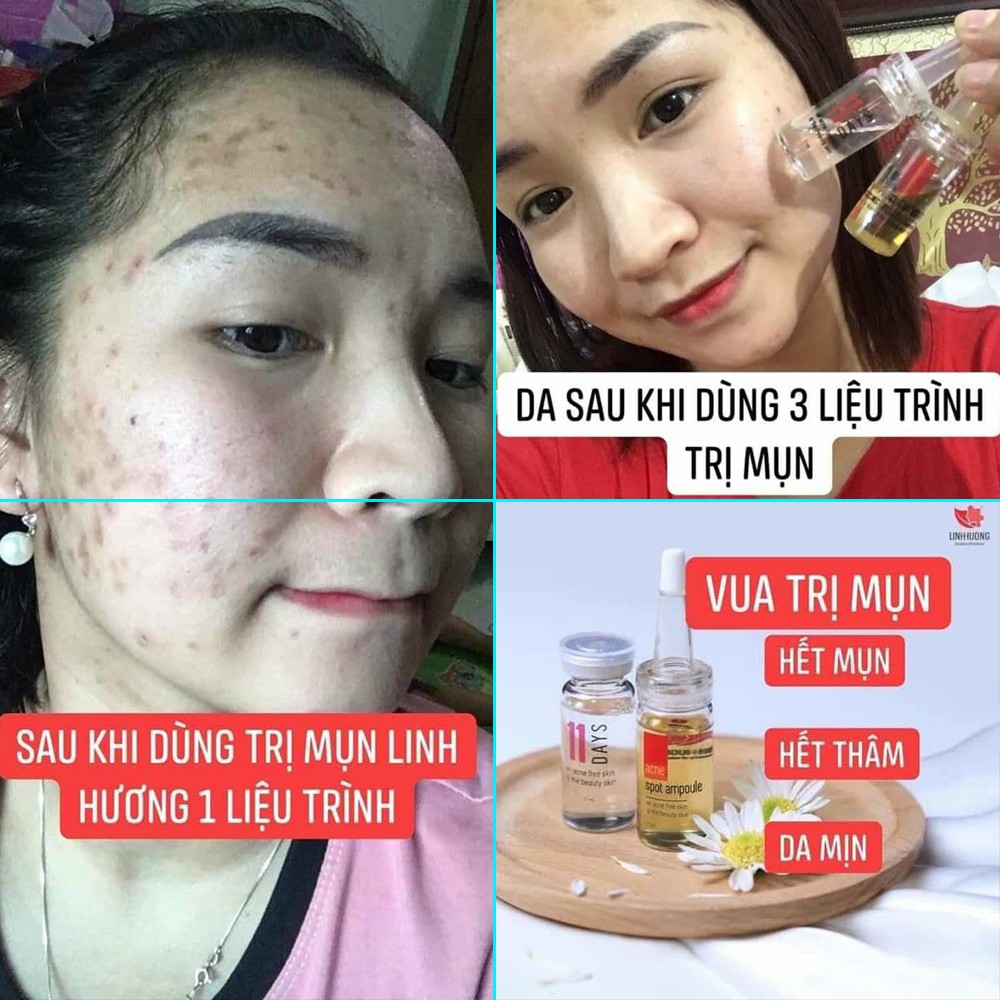 Bộ serum dưỡng da ngăn ngừa mụn hiệu quả cho da da dầu da nhạy cảm  PURITY SKIN Linh Hương