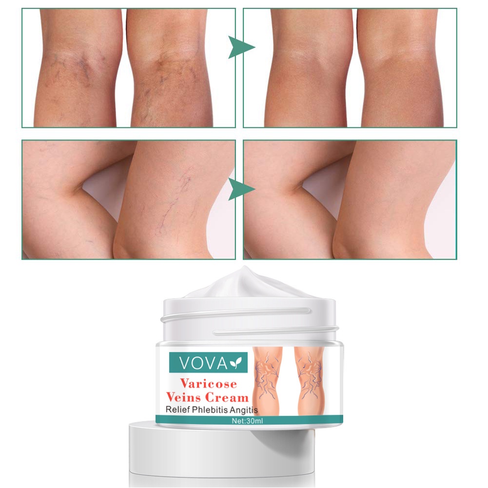 Kem giãn tĩnh mạch VOVA , sửa chữa các mao mạch, VOVA varicose veins cream 30ml