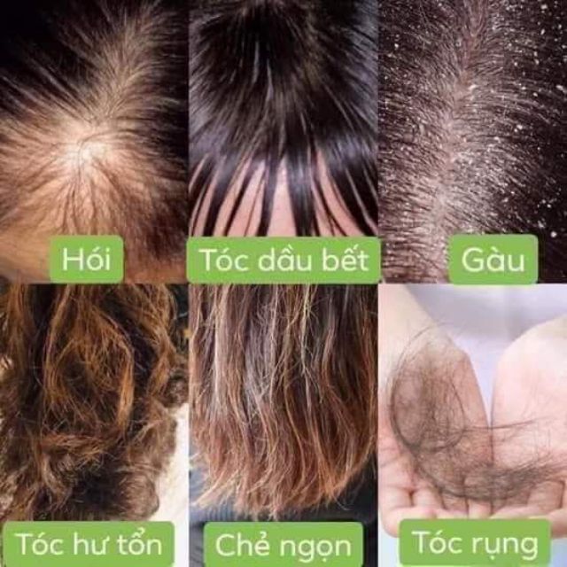 Combo chăm sóc tóc  chuyên trị rụng tóc ,gàu nhiều, nấm,ngứa da đầu