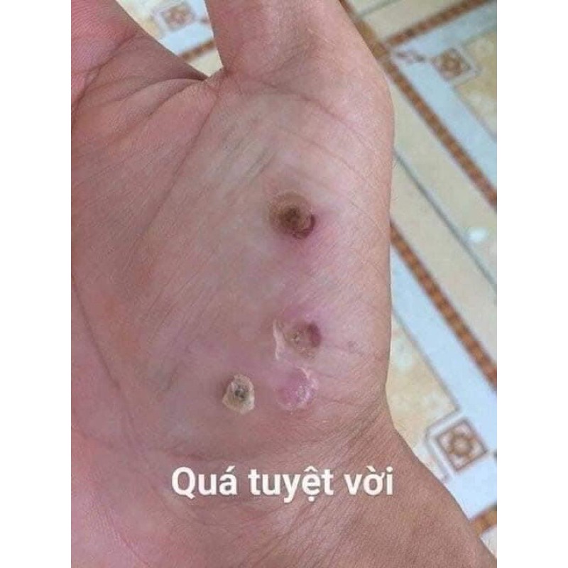 [Chính Hãng] Mụn Cóc Mụn Cơm Mắt Cá 15ml | BigBuy360 - bigbuy360.vn