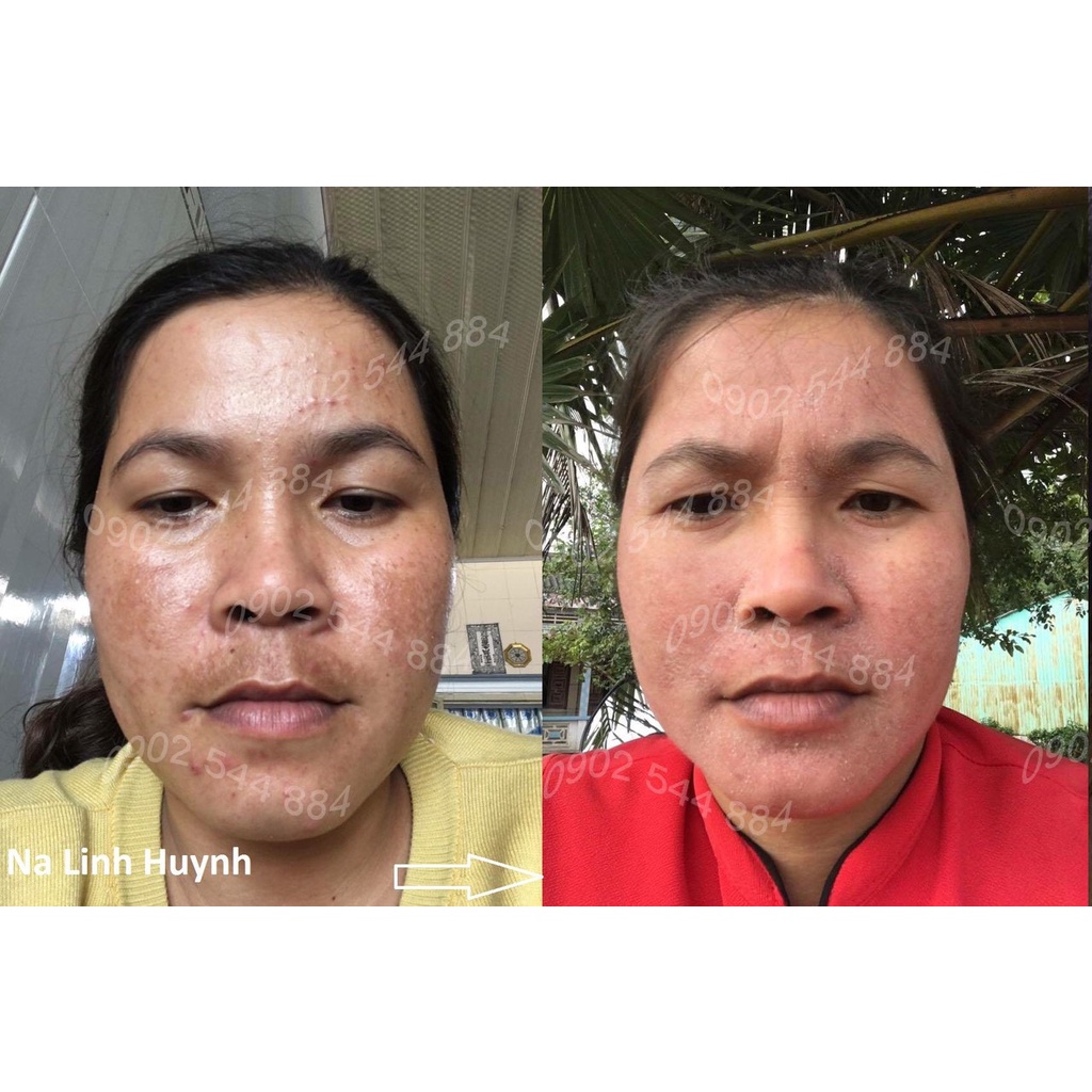 Serum nám Hoàng Trinh