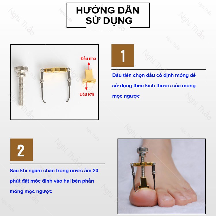 Dụng cụ điều chỉnh cố định móng mọc ngược