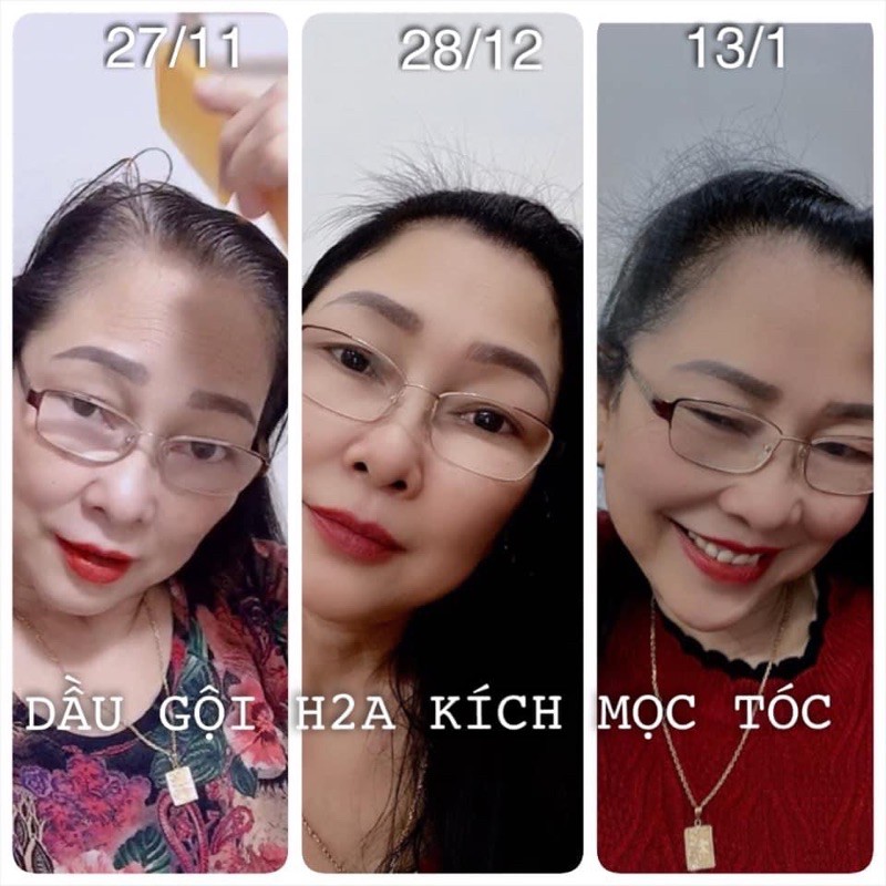 COMBO NGĂN RỤNG TÓC, KÍCH THÍCH MỌC TÓC H2A | BigBuy360 - bigbuy360.vn