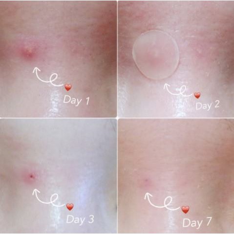 Miếng dán mụn Mayan Care Ultra This Spot Acne Patch - Màu ngẫu nhiên