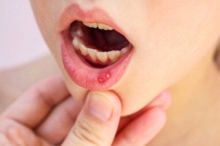 Thuốc xịt nhiệt miệng Nhật Traful