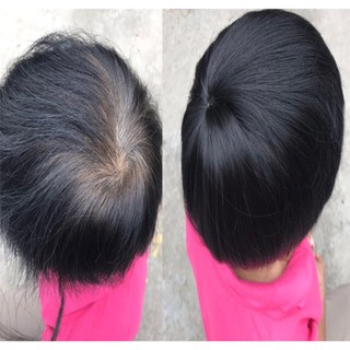 [ Video thật ] Tóc giả che hói đỉnh đầu- mẫu mới