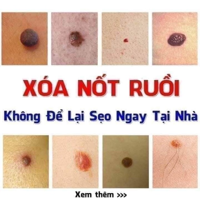 Tẩy nốt ruồi Nga